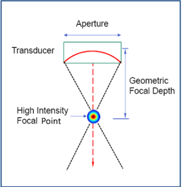 HIFU Diagram